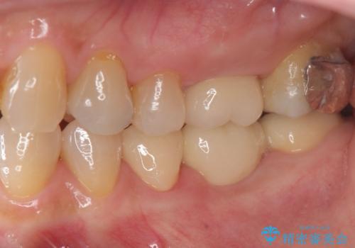 抜歯後の補綴 セラミックブリッジ治療の治療後
