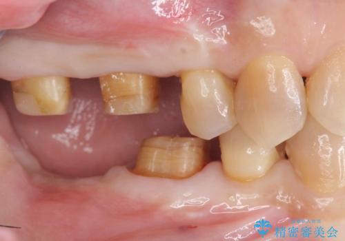 食いしばりが強い 歯周病全顎治療の治療中