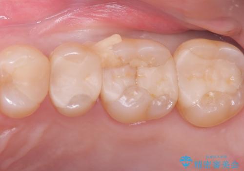 【セラミックインレー】詰め物が欠けた