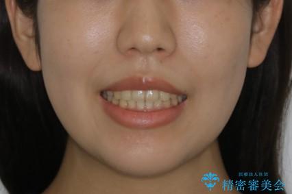インビザラインが使えなかった:ワイヤーで仕上げ治療の治療後(顔貌)