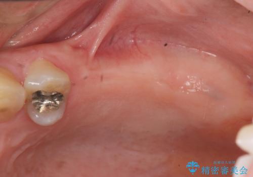 奥歯でしっかり噛める、インプラント治療の治療前