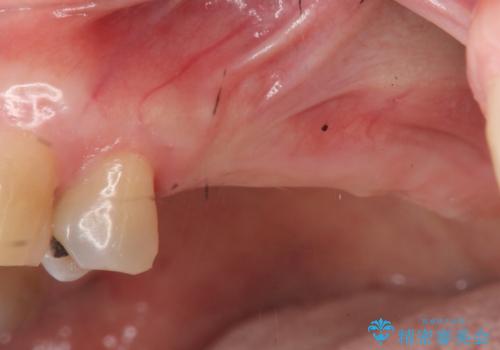 奥歯でしっかり噛める、インプラント治療の治療前