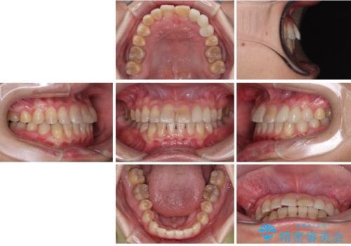 全体的なデコボコが気になる。拡大装置を併用したワイヤー矯正の治療後