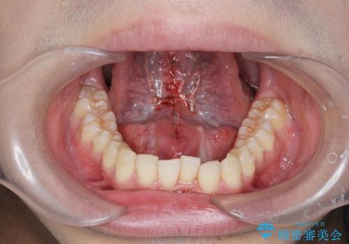 滑舌の改善 舌小帯の形成術の治療中