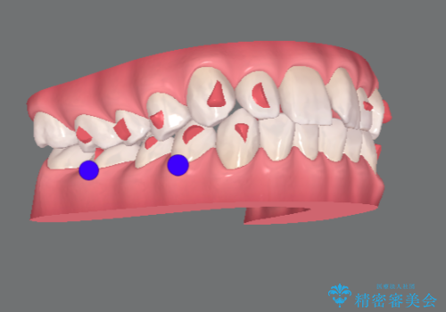 前歯のねじれを治したい マウスピース矯正治療