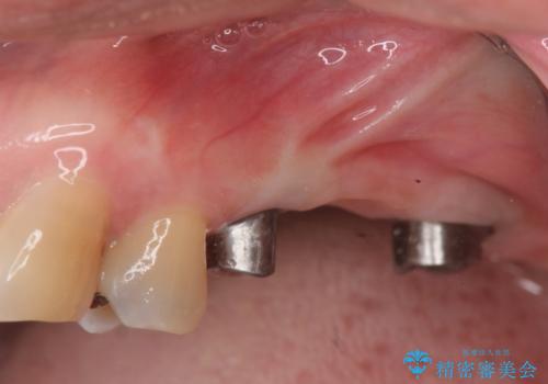 奥歯でしっかり噛める、インプラント治療の治療中