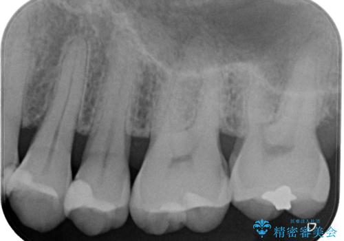 レントゲンで虫歯を発見 セラミックインレーの治療前