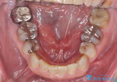 食いしばりが強い 歯周病全顎治療の治療前