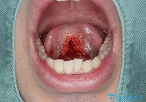 滑舌の改善 舌小帯の形成術の治療中