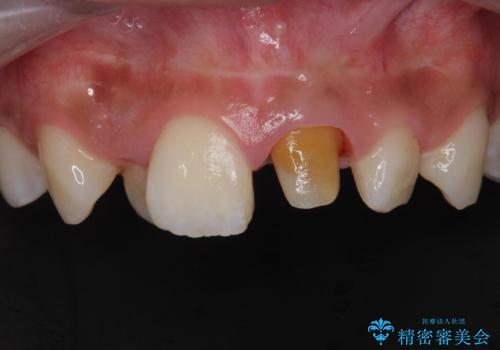 前歯の見た目が気になる。の治療中