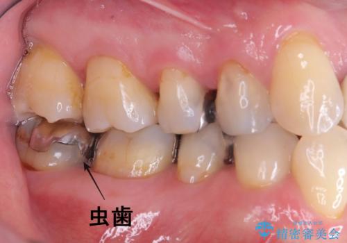 【オールセラミッククラウン】銀歯の下が虫歯に!の治療前