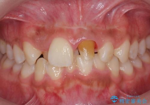 前歯の見た目が気になる。の治療中