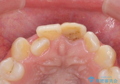 前歯の見た目が気になる。の治療前