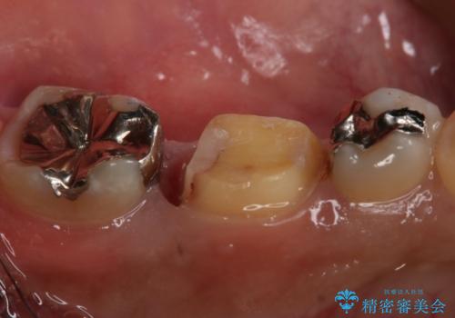 フルジルコニアクラウンによる銀歯のやり変えの治療中