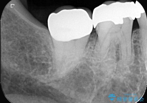 【オールセラミッククラウン】銀歯の下が虫歯に!の治療後