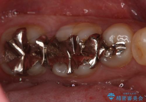 フルジルコニアクラウンによる銀歯のやり変えの治療前