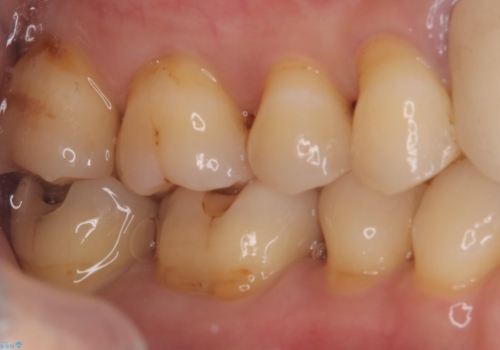 【セラミックインレー】プラスチックの劣化が気になるの治療中