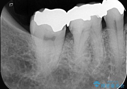 【オールセラミッククラウン】銀歯の下が虫歯に!の治療前