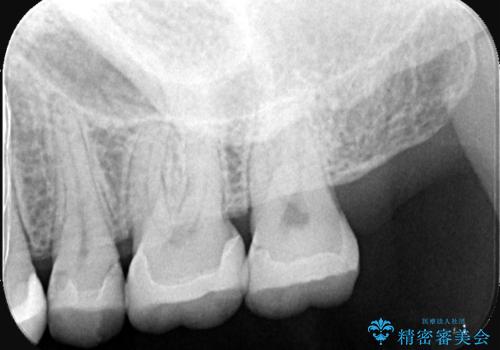 【セラミックインレー】詰め物が欠けたの治療後