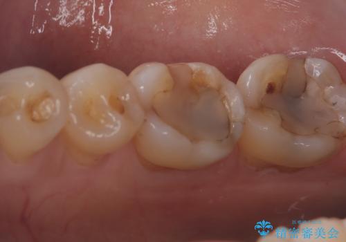 【セラミックインレー】プラスチックの劣化が気になるの治療前