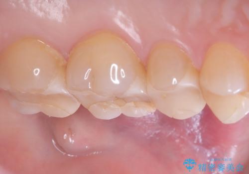 【セラミックインレー】詰め物が欠けたの治療前