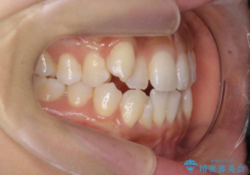 【審美装置】八重歯気になるの治療前