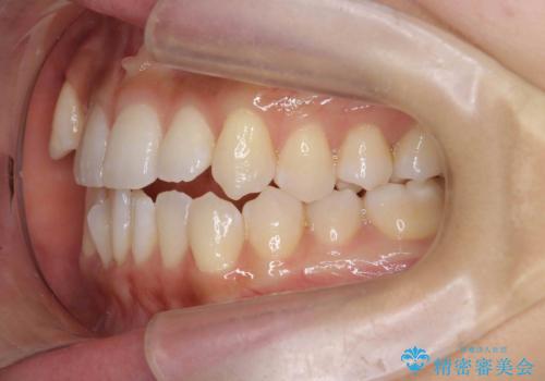 【審美装置】八重歯気になるの治療前