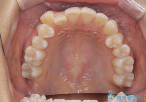 【審美装置】八重歯気になるの治療前