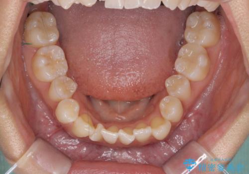 【審美装置】八重歯気になるの治療前