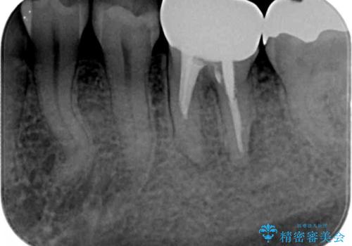汚れの溜まりやすい銀歯を精度の高いセラミック治療で改善の治療前