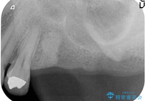 奥歯でしっかり噛める、インプラント治療の治療前