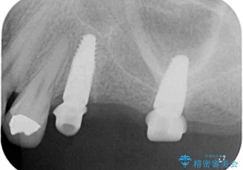 奥歯でしっかり噛める、インプラント治療の治療中