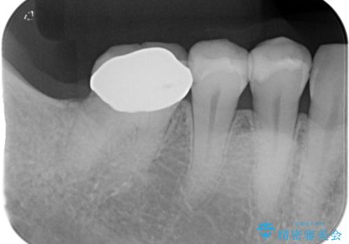 放置した奥歯 部分矯正を併用したインプラント補綴治療の治療前