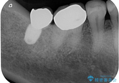放置した奥歯 部分矯正を併用したインプラント補綴治療の治療後