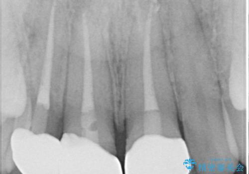 自転車で転んで前歯を損傷 前歯のオールセラミッククラウンの治療後