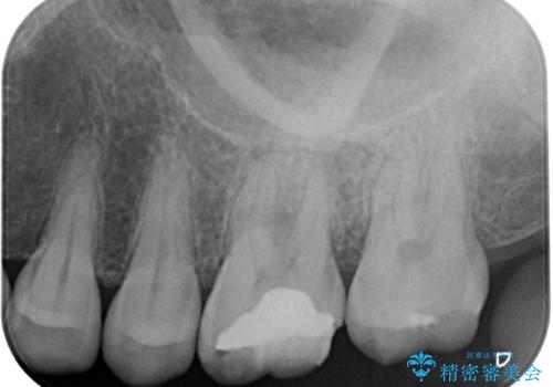 痛みを感じる上顎大臼歯　ゴールドクラウンの補綴治療の治療前