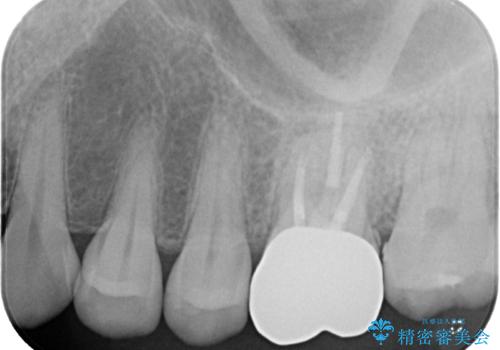 痛みを感じる上顎大臼歯　ゴールドクラウンの補綴治療の治療後