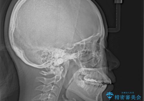 口元の突出感を改善したい。リンガルアーチを併用した抜歯矯正の治療前