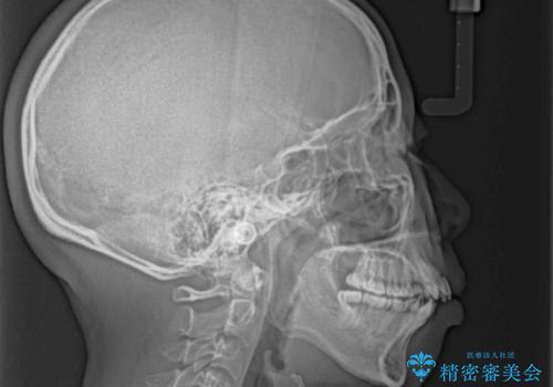 八重歯と上顎前突 ワイヤー装置での抜歯矯正の治療前