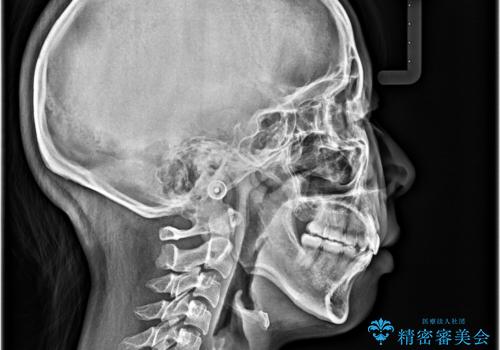 八重歯と上顎前突 ワイヤー装置での抜歯矯正の治療後