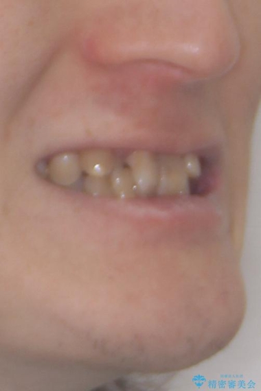 全体的なデコボコが気になる。拡大装置を併用したワイヤー矯正の治療前(顔貌)