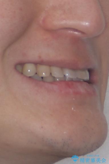 全体的なデコボコが気になる。拡大装置を併用したワイヤー矯正の治療後(顔貌)