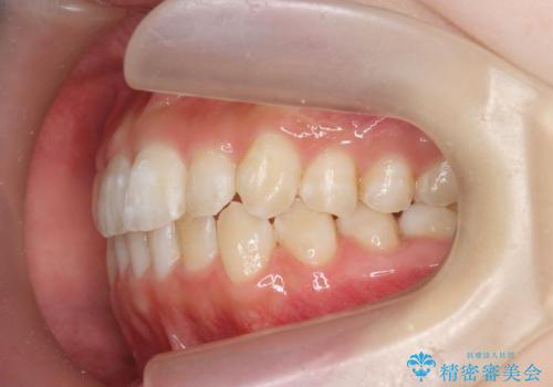 前歯のねじれを治したい マウスピース矯正治療の治療中