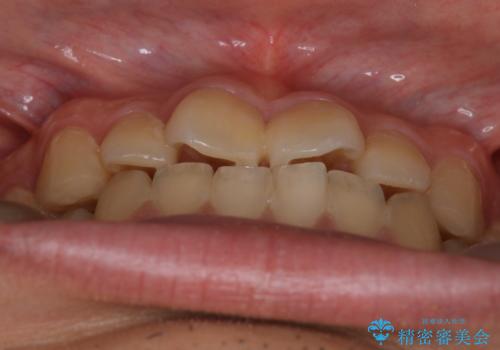 【クリア装置】前歯のがたつきが気になるの治療前