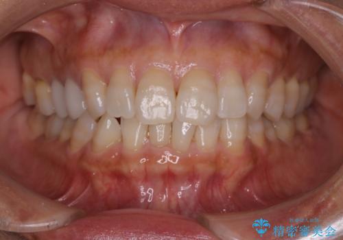 【インビザライン】下前歯だけを治したいの治療前