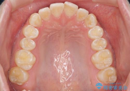 前歯のねじれを治したい マウスピース矯正治療の治療中
