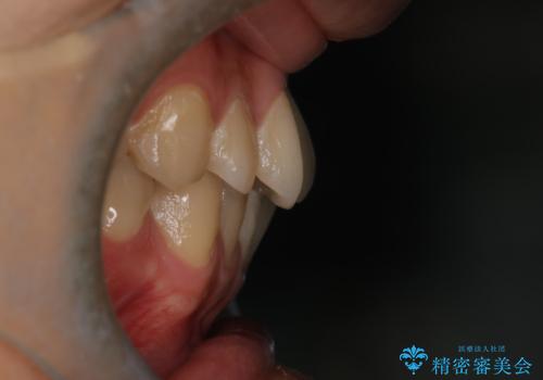 【クリア装置】前歯のがたつきが気になるの治療前