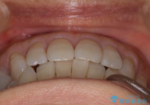 【インビザライン】下前歯だけを治したいの治療前