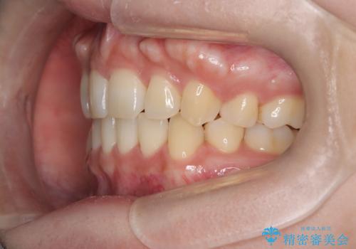 前歯のデコボコを抜歯矯正で改善|アンカースクリューで口元もスッキリの治療後