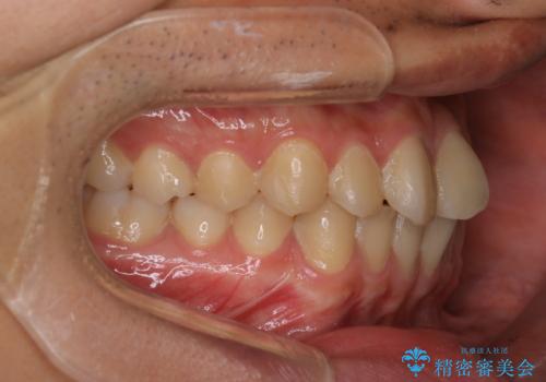 【クリア装置】前歯のがたつきが気になるの治療前